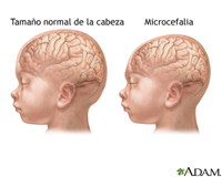La microcefalia se caracteriza por el tamaño menor al normal de la cabeza del recién nacido presenta un tamaño,  no es un problema nuevo, y no es el Zika el que lo ha producido por primera vez.